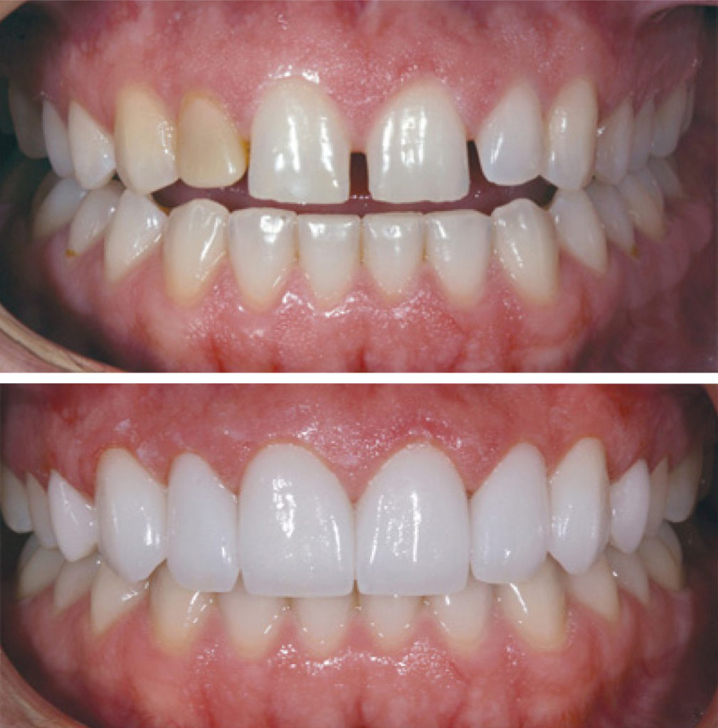 Veneers by Yaletown Dentist Vancouver ABAN Yaletown Dental